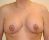 Feel Beautiful - Breast Lift 266 - After Photo
